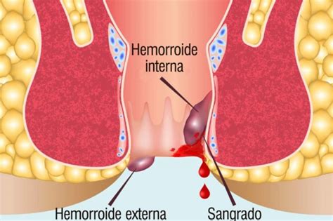 fotos reales de hemorroides|Hemorroides o almorranas: tipos, tratamientos y fotos